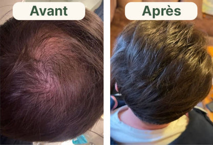 Kit Renouvellement Capillaire